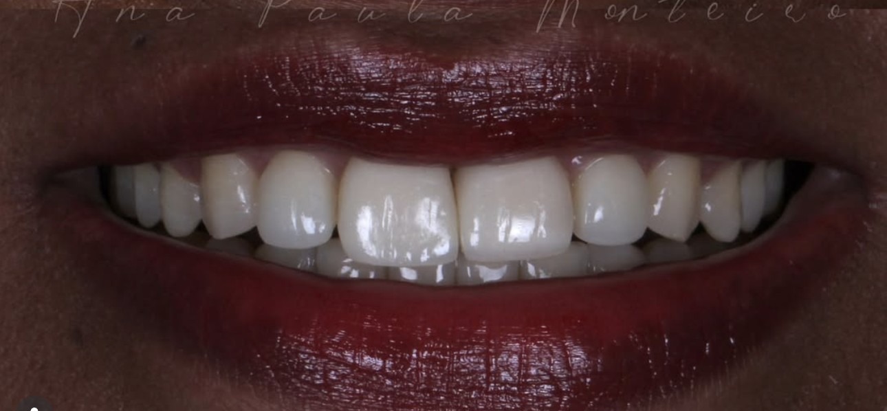 Depois — Função e estética